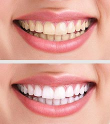 Zähne vor und nach einer Vorsorgebehandlung